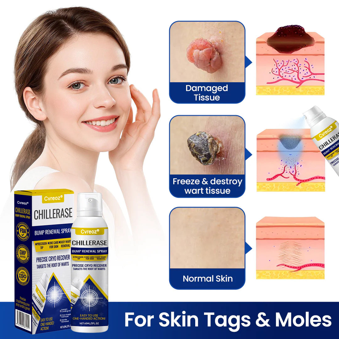 Cvreoz® Professional Cryo-Spray for Warts & Skin Tags - Safe & Effective at Home