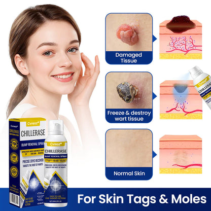 Cvreoz® Professional Cryo-Spray for Warts & Skin Tags - Safe & Effective at Home
