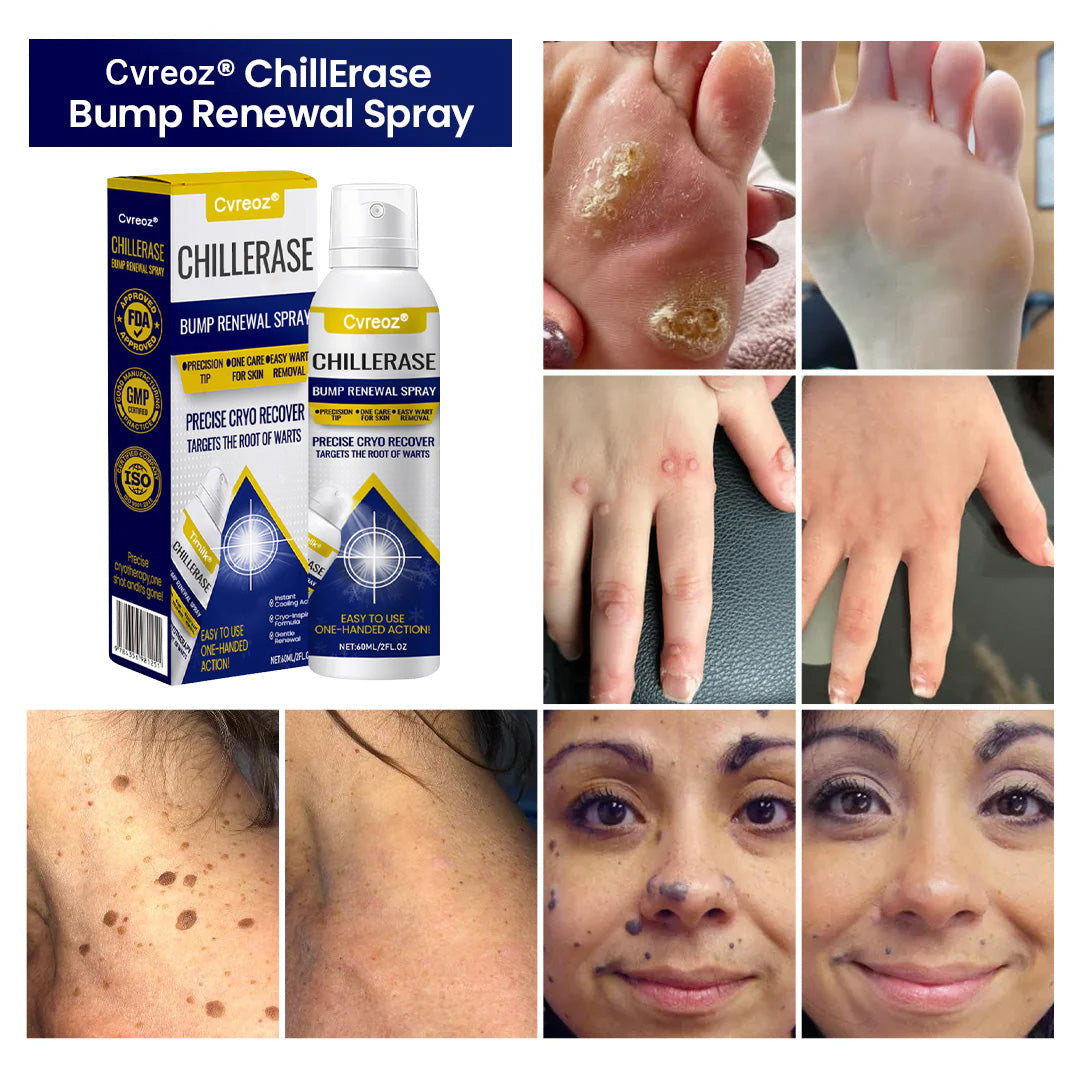Cvreoz® Professional Cryo-Spray for Warts & Skin Tags - Safe & Effective at Home