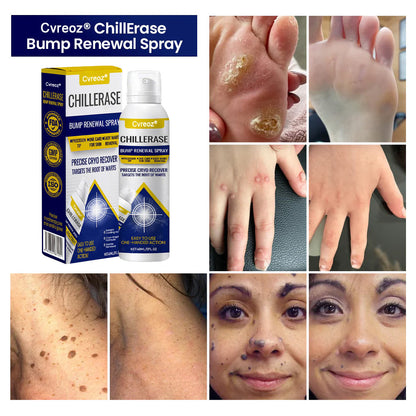 Cvreoz® Professional Cryo-Spray for Warts & Skin Tags - Safe & Effective at Home