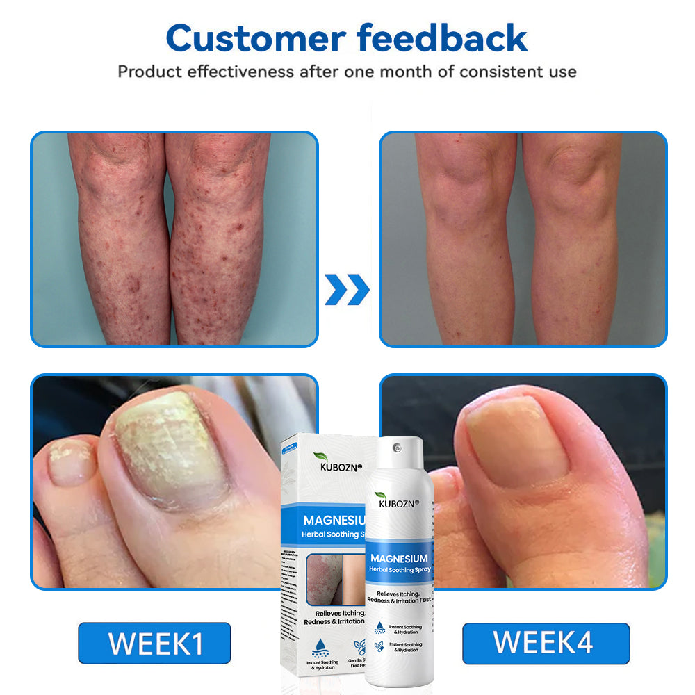 ✅  Official Store: KUBOZN® Magnesium Herbal Psoriasis Spray ⚕️ FDA Certified