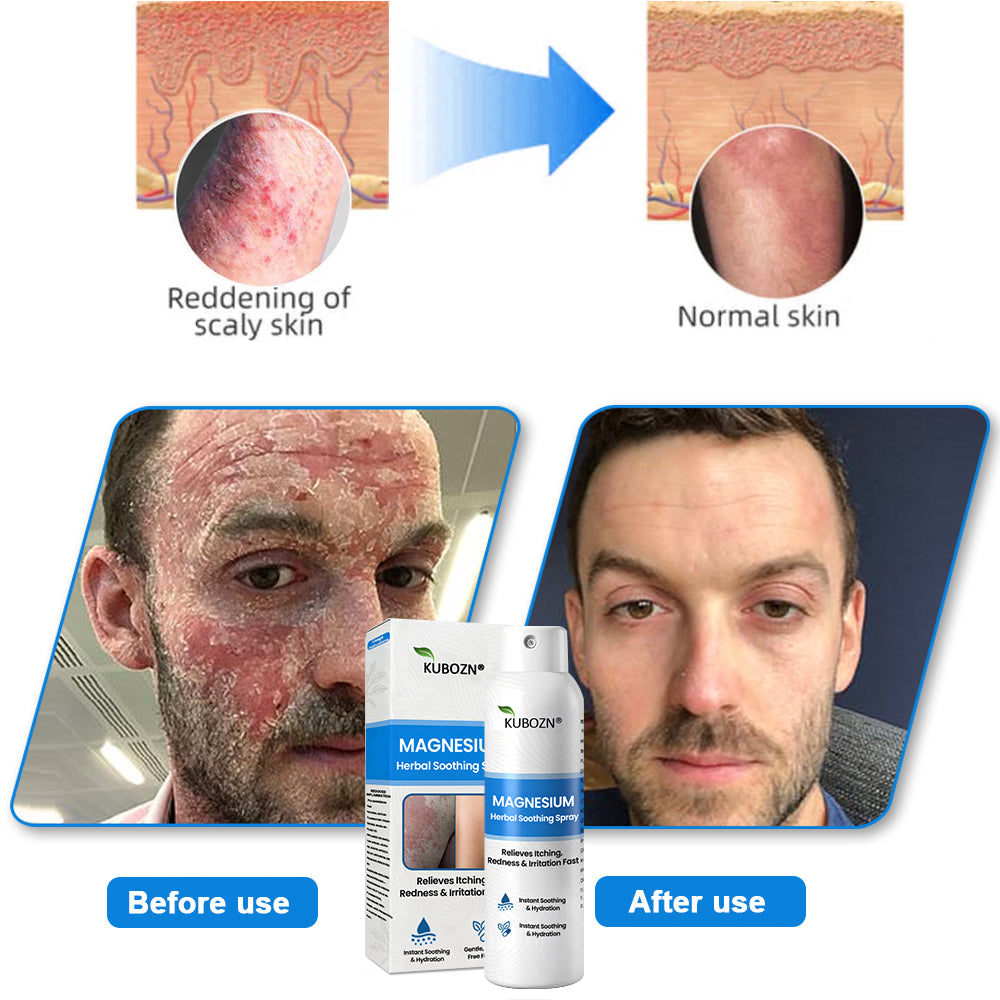 ✅  Official Store: KUBOZN® Magnesium Herbal Psoriasis Spray ⚕️ FDA Certified