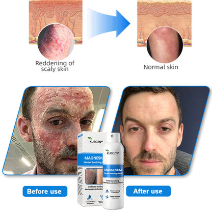 ✅  Official Store: KUBOZN® Magnesium Herbal Psoriasis Spray ⚕️ FDA Certified
