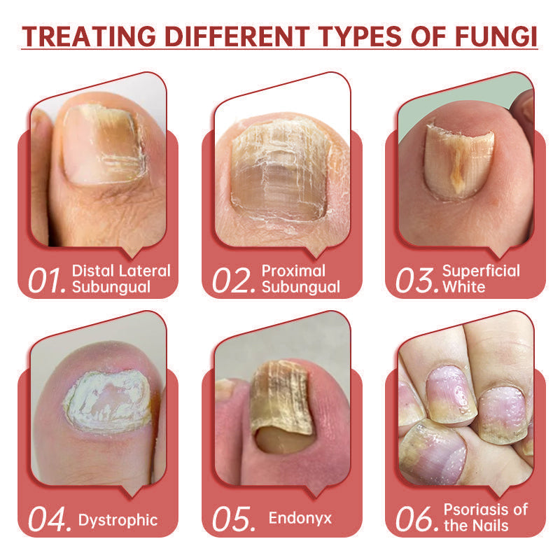 Cvreoz®  Toenail Fungus Treatment | Triple-Action Repair Formula-Plant-Based Formula | MHRA-Registered (ofter)