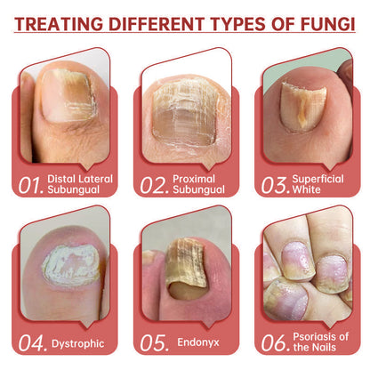 Cvreoz®  Toenail Fungus Treatment | Triple-Action Repair Formula-Plant-Based Formula | MHRA-Registered (ofter)